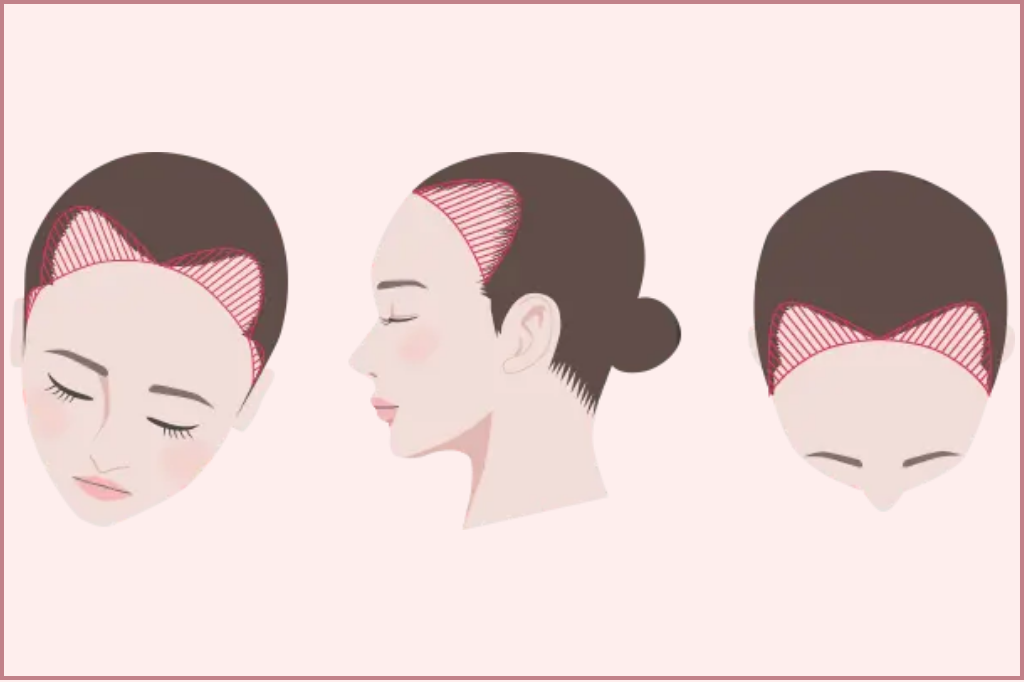 女性FAGA・女性の薄毛への自毛植毛