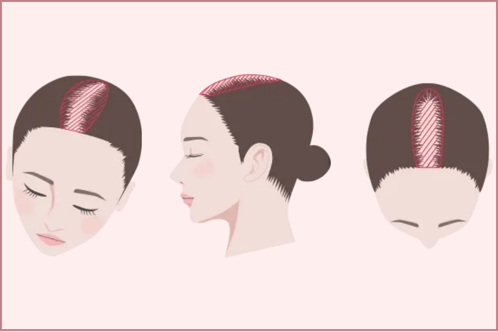 女性FAGA・女性の薄毛への自毛植毛