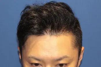 術後の経過タイムライン