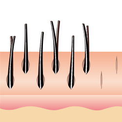 従来の自毛植毛手術の植毛イメージ