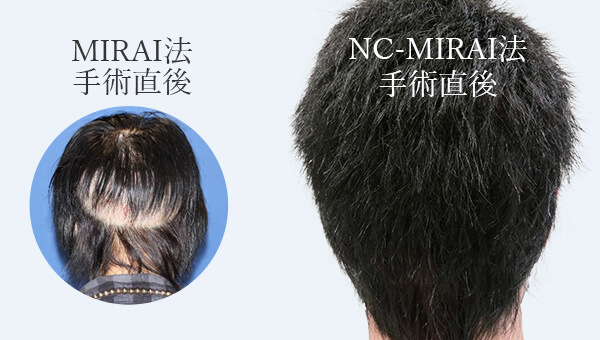 最新の自毛植毛術「NC-MIRAI法」