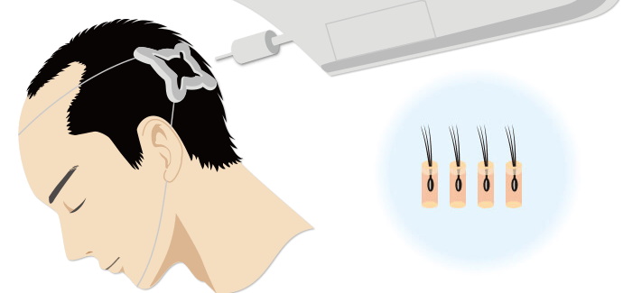 ロボット植毛のイラスト