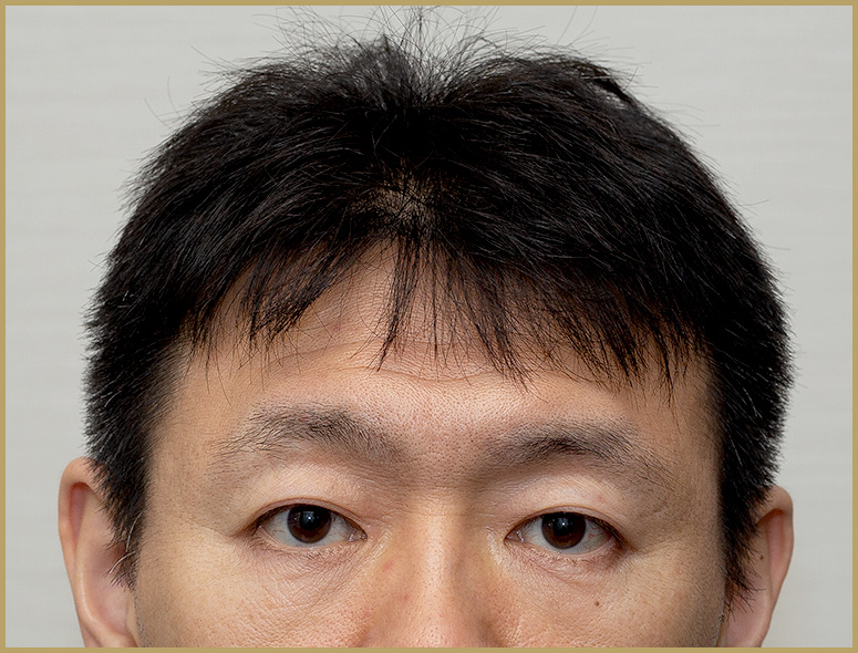 40代 男性 O.Tさんの頭部写真2（施術前）