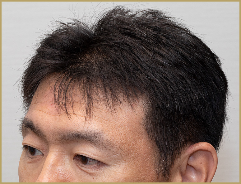 40代 男性 O.Tさんの頭部写真1（施術後）