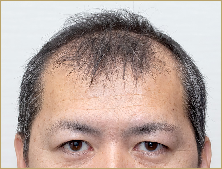 40代 男性 H.Tさんの頭部写真2（施術前）