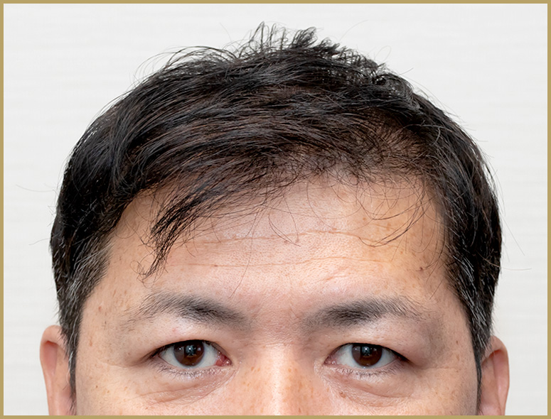 40代 男性 H.Tさんの頭部写真2（施術後）