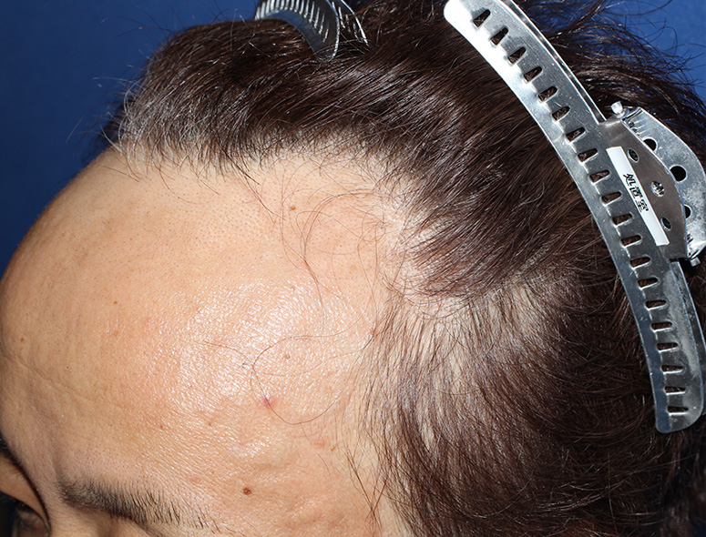 30代 男性 F.K.さんの頭頂部写真（施術後）