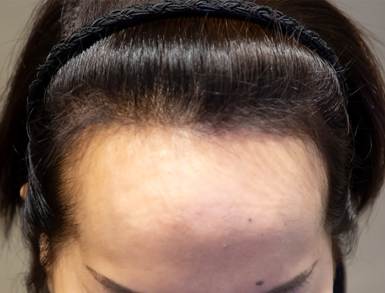 50代女性M.Mさんの頭部写真2（施術前）
