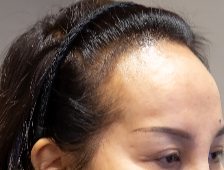 50代女性M.Mさんの頭部写真3（施術前）
