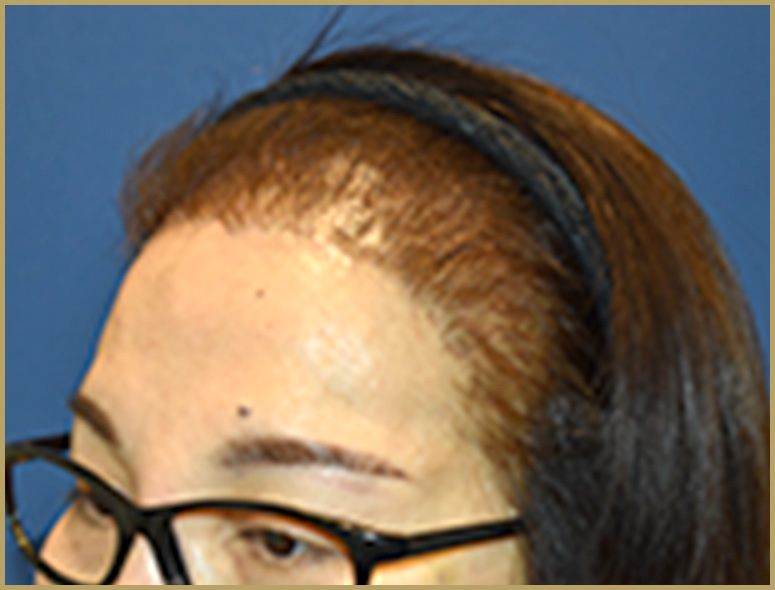 50代女性M.Mさんの頭部写真1（術後4ヶ月）