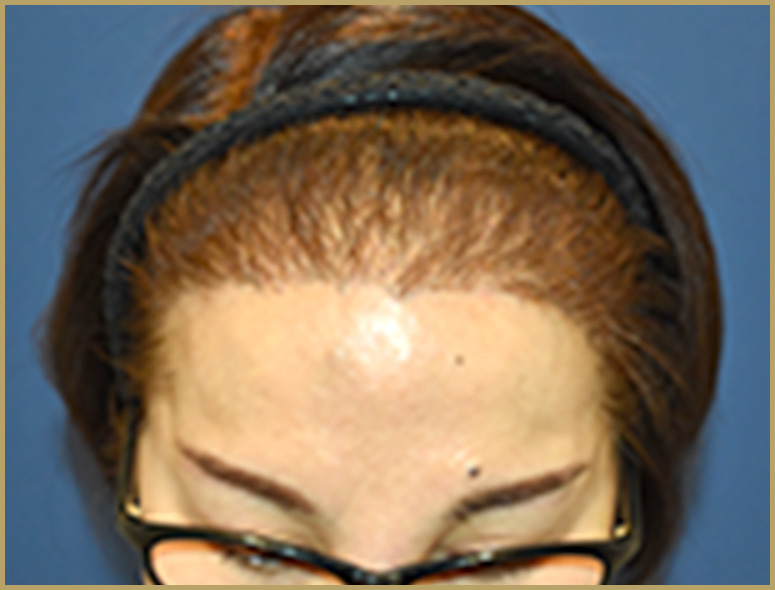 50代女性M.Mさんの頭部写真2（術後4ヶ月）