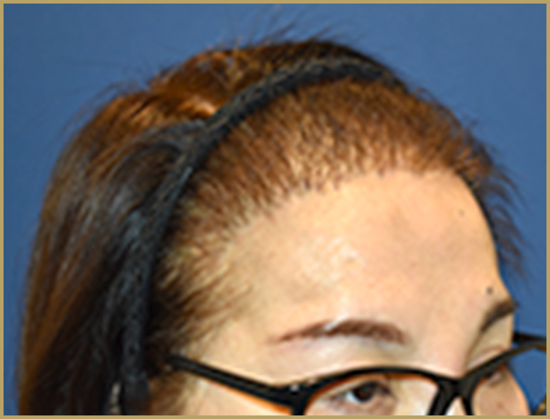 50代女性M.Mさんの頭部写真3（術後4ヶ月）