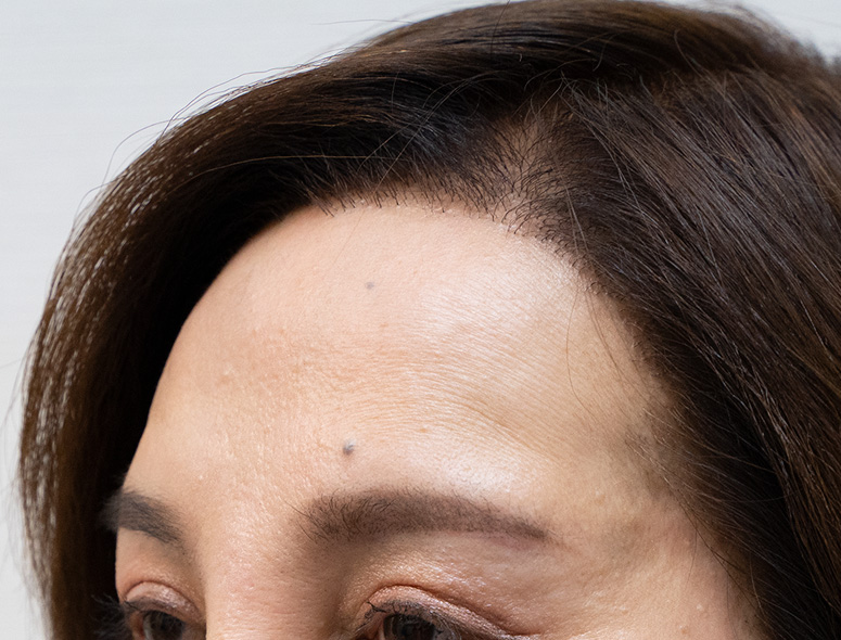 50代女性M.Mさんの頭部写真1（施術後）