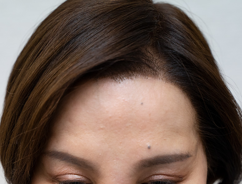 50代女性M.Mさんの頭部写真2（施術後）