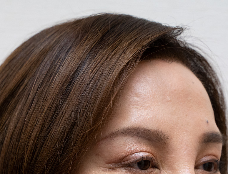 50代女性M.Mさんの頭部写真3（施術後）