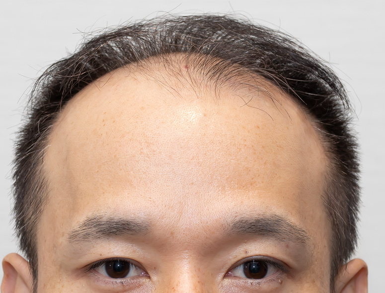 30代男性S.Yさんの頭部写真2（施術前）