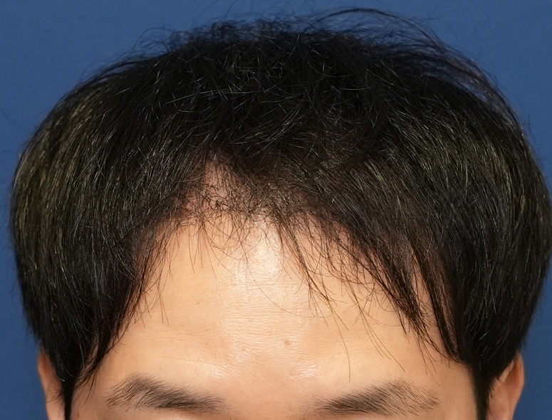 30代 男性 Y.Dさんの頭部写真2（術後4ヶ月）