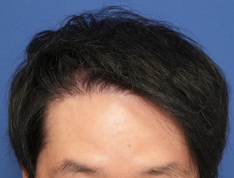 30代 男性 Y.Dさんの頭部写真2（施術後）