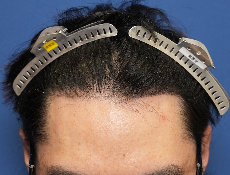 30代男性Y.Oさんの頭部写真2（施術後）