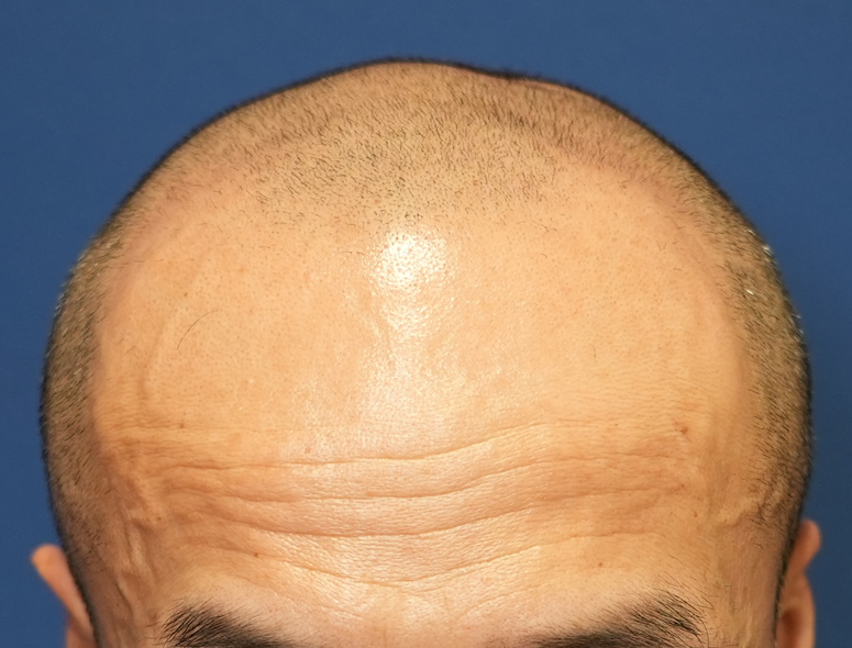 50代男性Y.Tさんの頭部写真2（施術前）