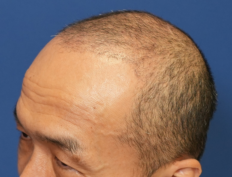 50代男性Y.Tさんの頭部写真1（術後4ヶ月）
