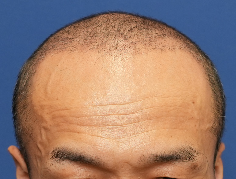 50代男性Y.Tさんの頭部写真2（術後4ヶ月）