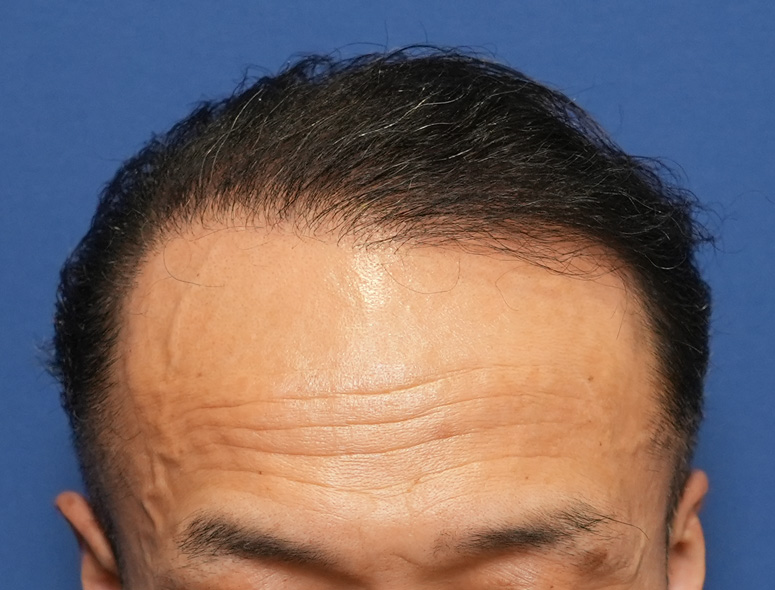 50代男性Y.Tさんの頭部写真2（施術後）