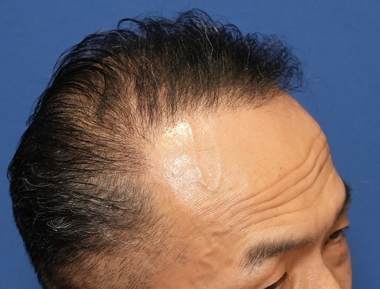 50代男性Y.Tさんの頭部写真3（施術後）