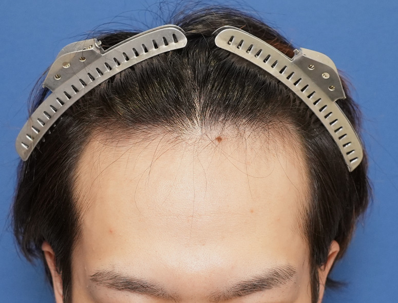 20代男性H.Mさんの頭部写真2（施術前）