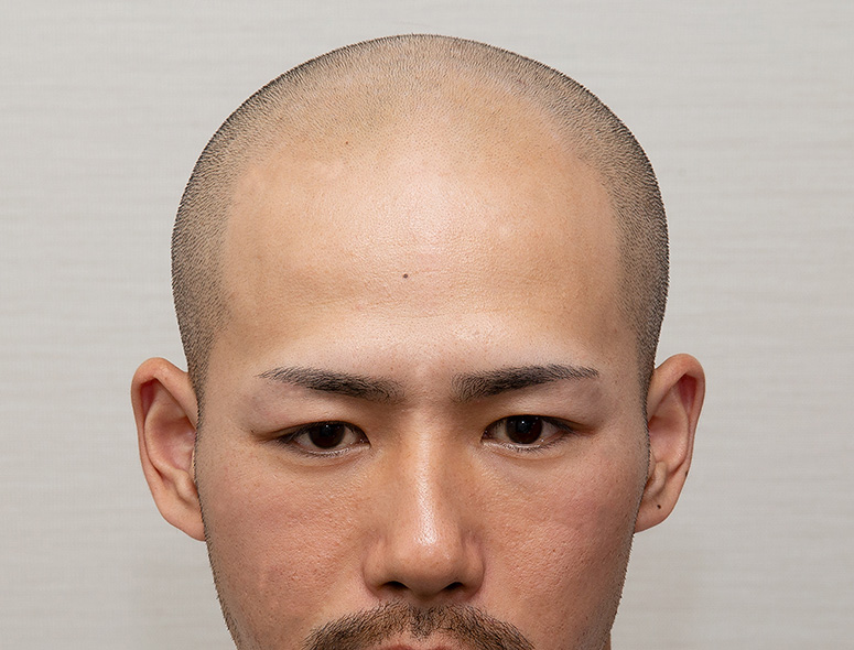 30代 男性 S.Yさんの頭部写真1（施術前）