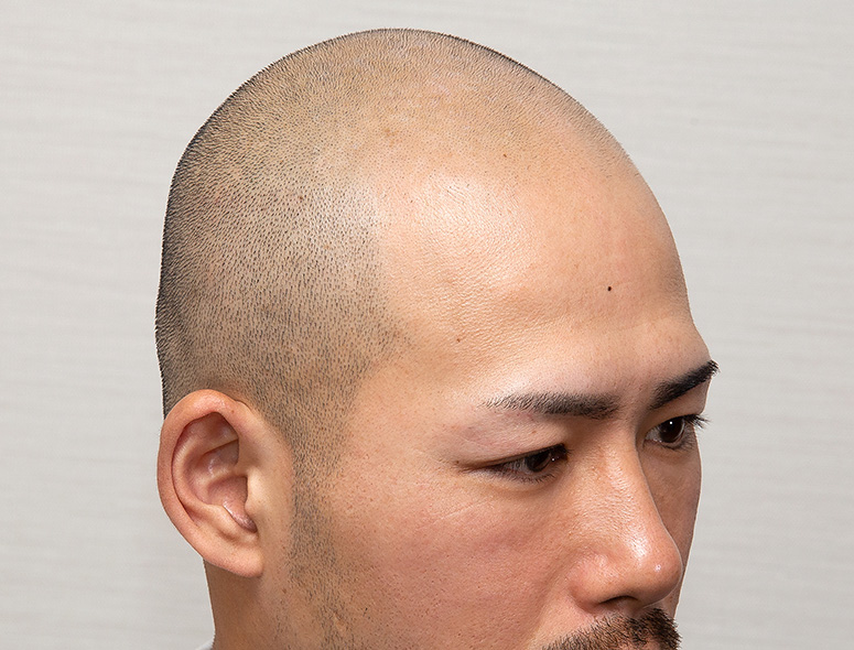 30代 男性 S.Yさんの頭部写真3（施術前）
