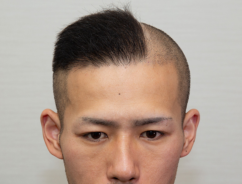 30代 男性 S.Yさんの頭部写真1（施術後）