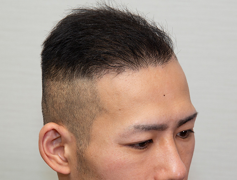 30代 男性 S.Yさんの頭部写真3（施術後）