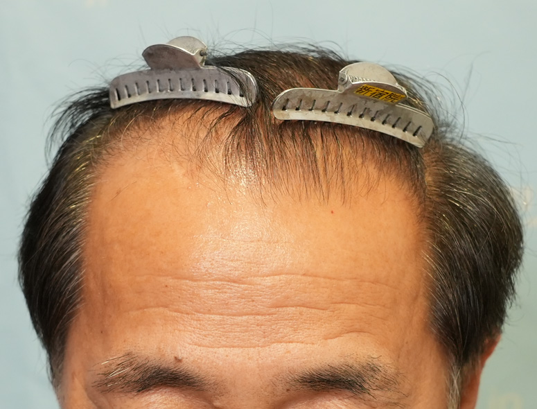 60代男性A.Mさんの頭部写真2（施術前）