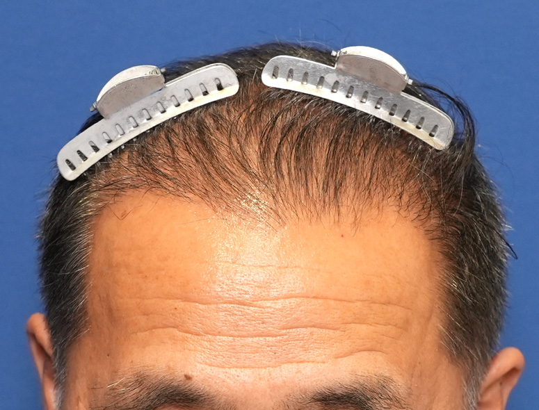 60代男性A.Mさんの頭部写真2（術後5ヶ月）