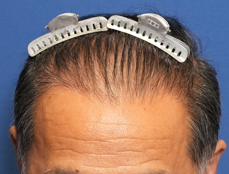 60代男性A.Mさんの頭部写真2（施術後）