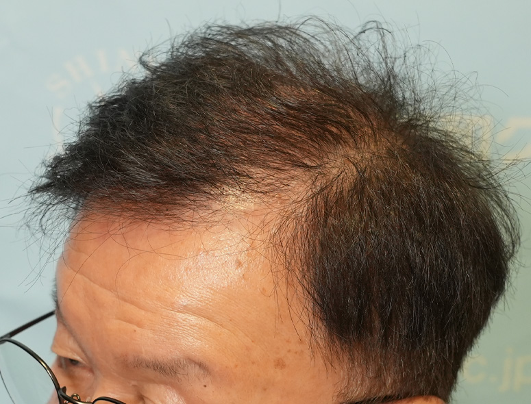 60代男性T.Mさんの頭部写真1（施術前）