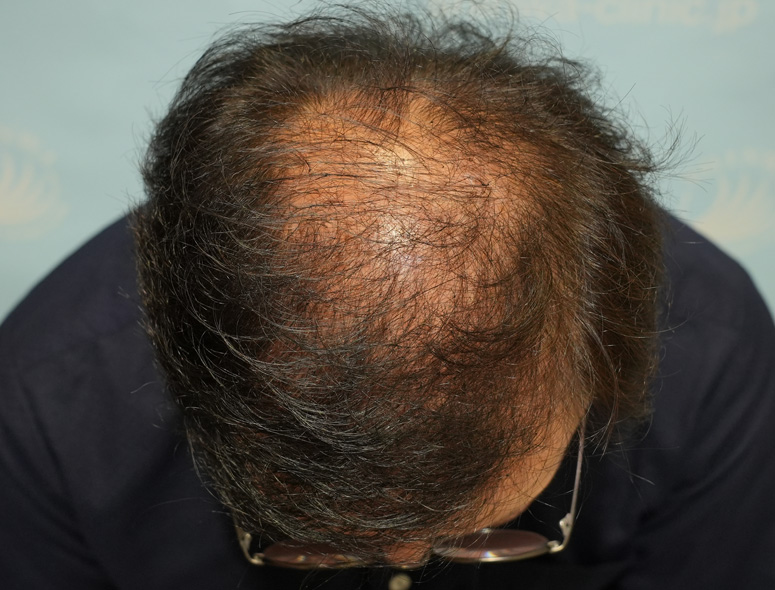 60代男性T.Mさんの頭部写真2（術前）