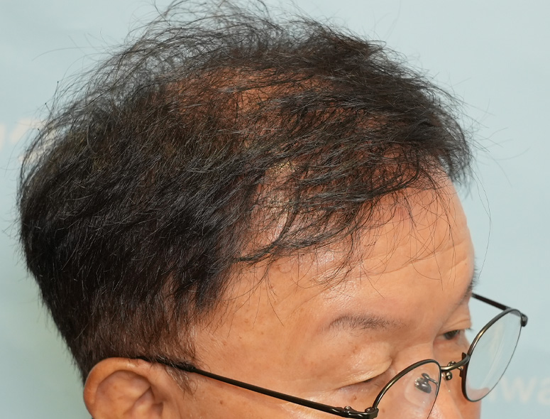 60代男性T.Mさんの頭部写真3（術前）