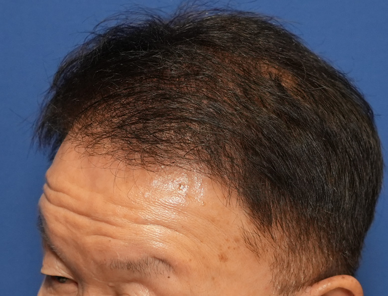 60代男性T.Mさんの頭部写真1（術後6ヶ月）