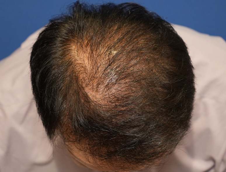 60代男性T.Mさんの頭部写真2（術後6ヶ月）