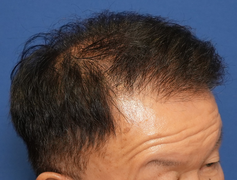 60代男性T.Mさんの頭部写真3（術後6ヶ月）