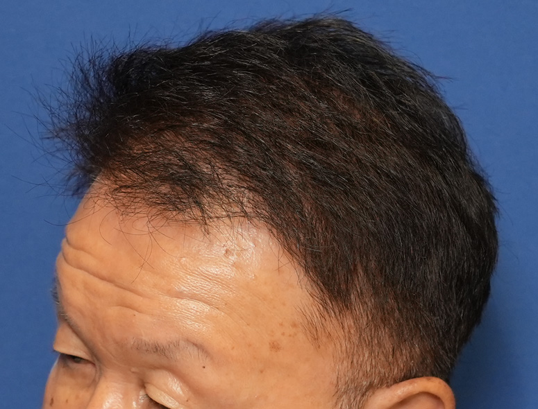60代男性T.Mさんの頭部写真1（術後1年）