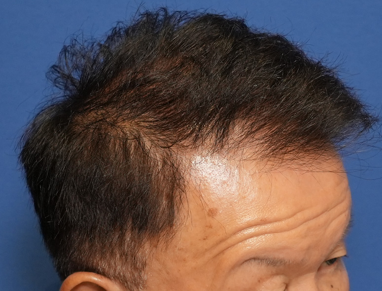 60代男性T.Mさんの頭部写真3（施術後）