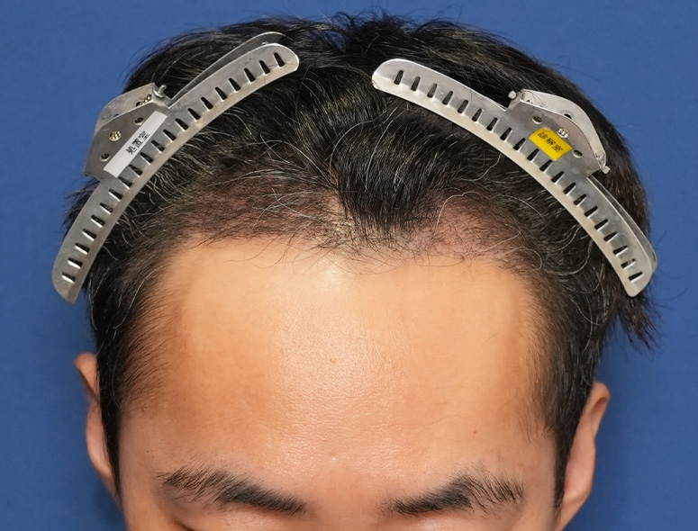 男性 T.Iさんの頭部写真2（術後3ヶ月）