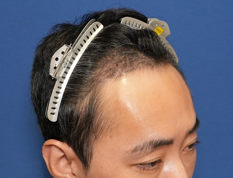 男性 T.Iさんの頭部写真3（術後4ヶ月）