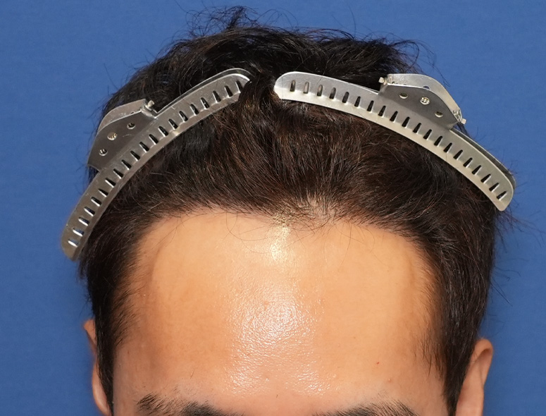男性 T.Iさんの頭部写真2（施術後）