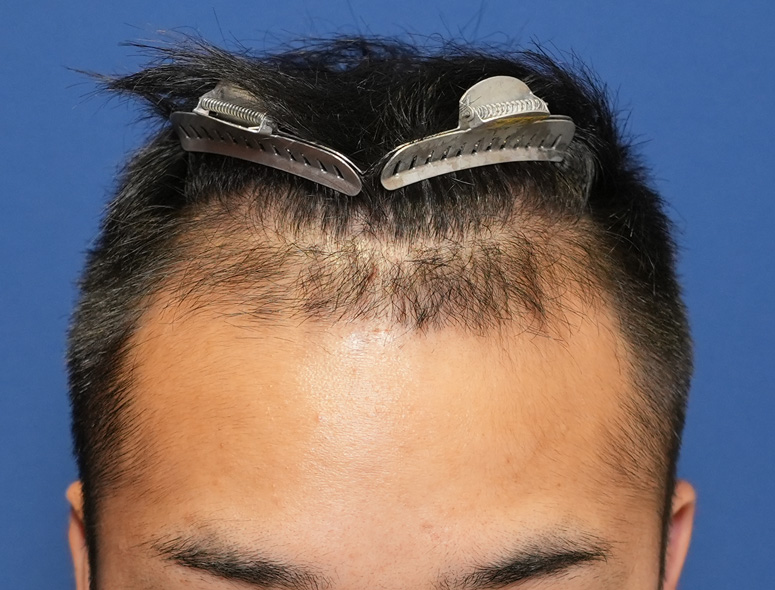 男性T.Iさんの頭部写真1（施術前）