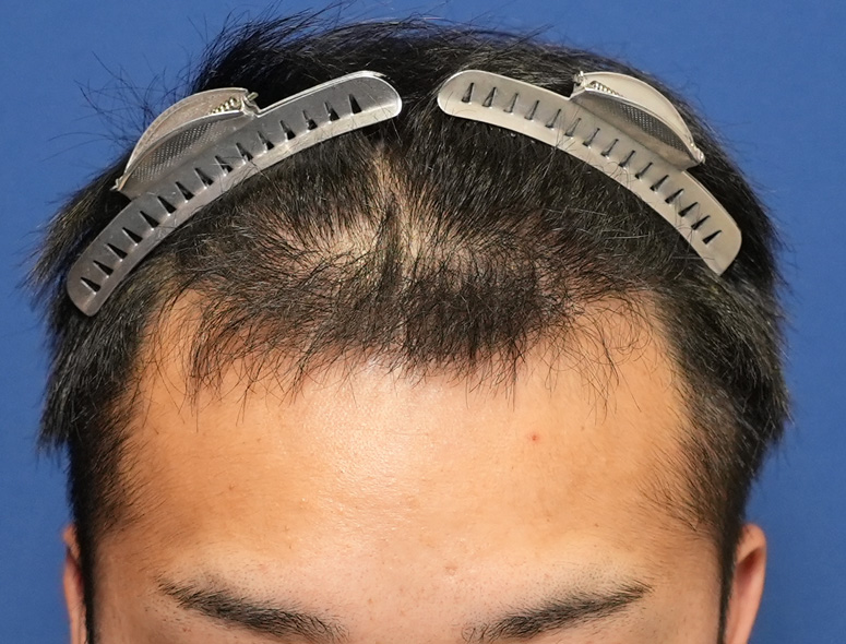 男性T.Iさんの頭部写真2（術後5ヶ月）
