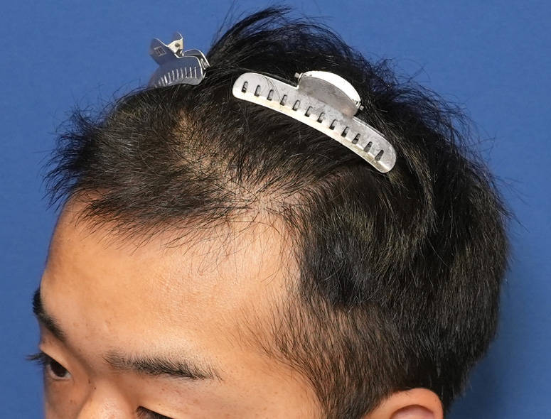 男性T.Iさんの頭部写真3（施術後）